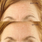 Ephylift - Kit visage - 5 patchs