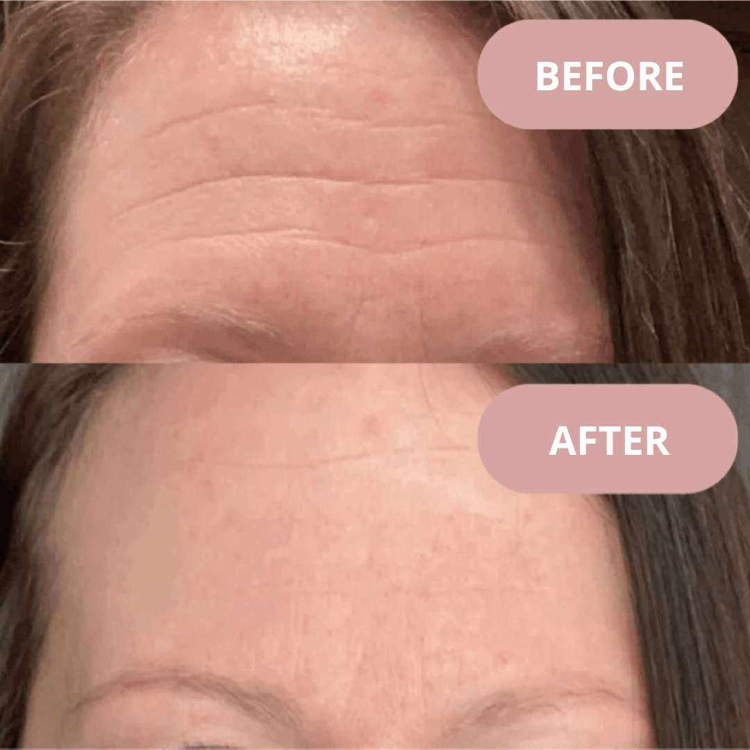 Ephylift - Kit para rostro, cuello y escote - 11 parches