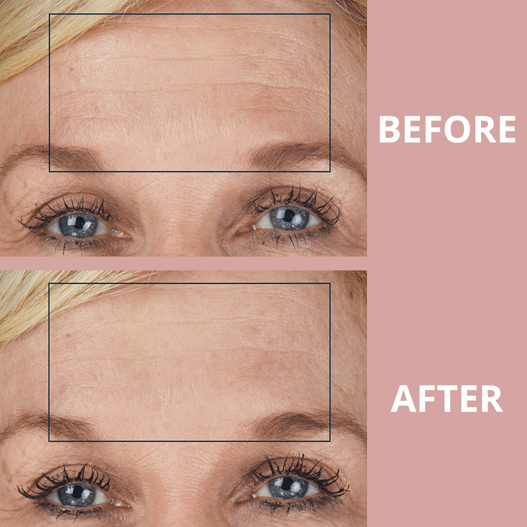 Ephylift - Kit para rostro, cuello y escote - 11 parches
